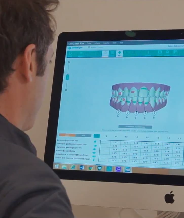 Invisalign by Issembert