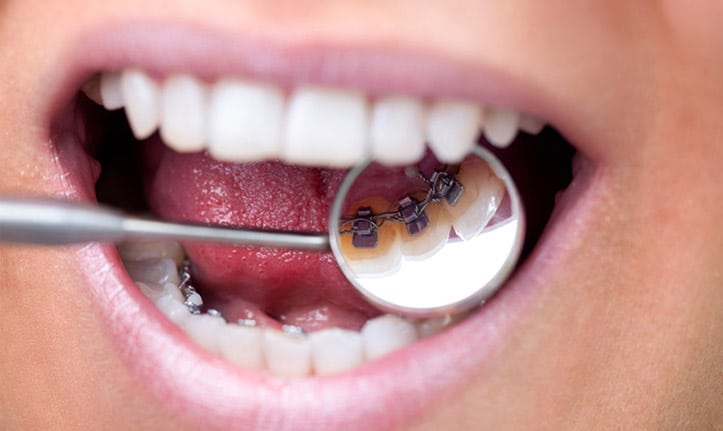 Guide sur les différents appareils en orthodontie chez l'adulte