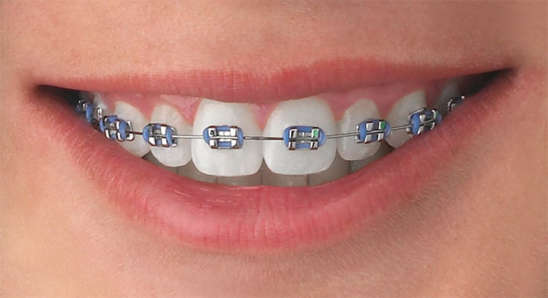 Bagues en métal orthodontiste paris