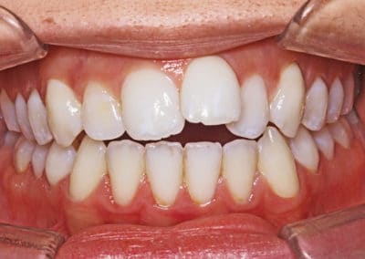 Invisalign avant / après : 3 exemples de traitements avec gouttières