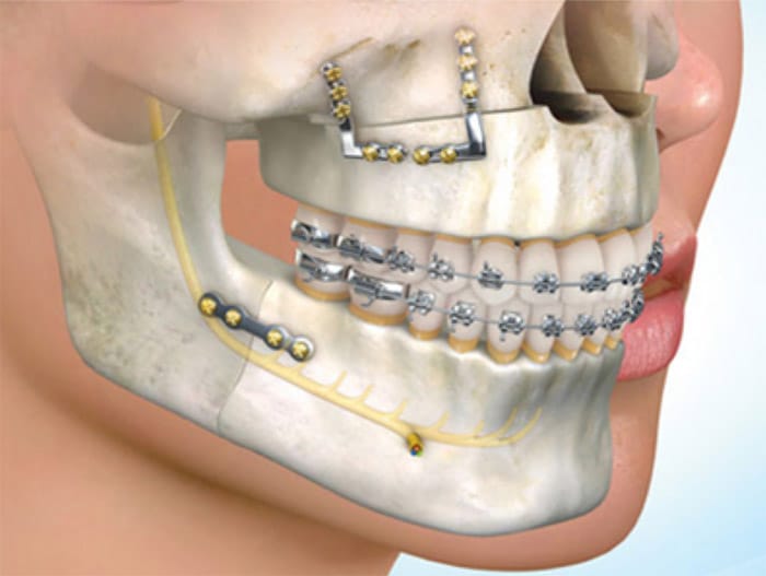 Orthodontie et Chirurgie | Chirurgie Orthognatique à Paris