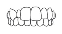 Articulé Croisé