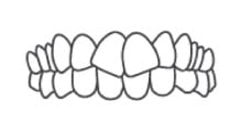 Chevauchements dents