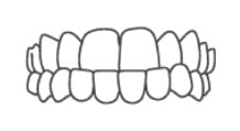Dents sous occlusion