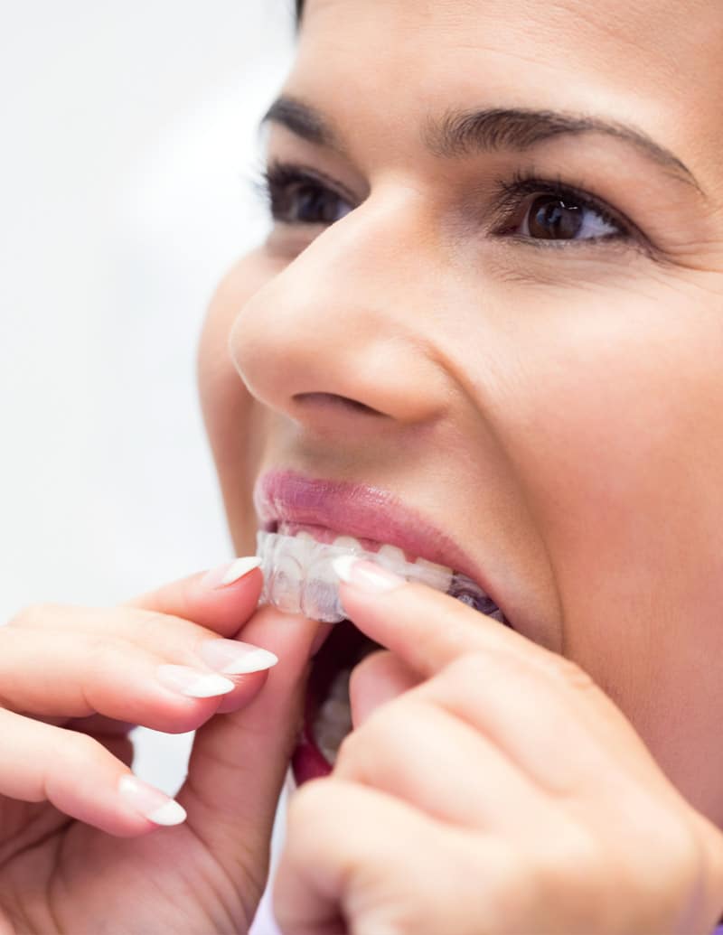 Invisalign pour adultes