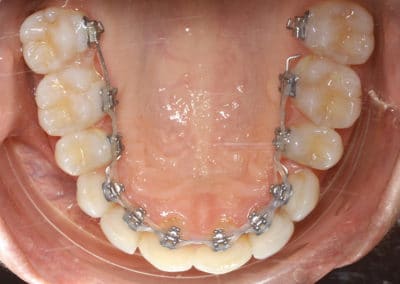 Orthodontie linguale