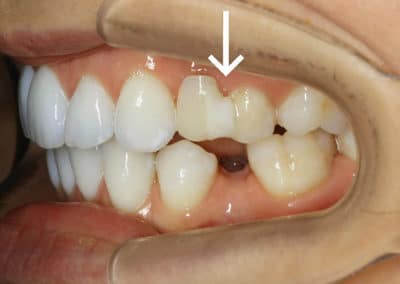 Orthodontie linguale