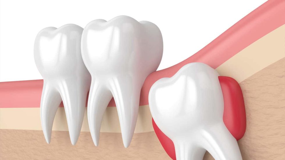 Dents de sagesse le guide pour tout savoir