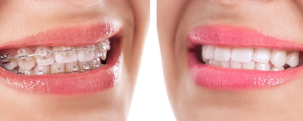 invisalign et bagues prise en charge