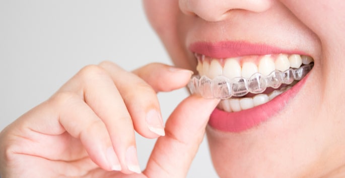 aligneurs transparents invisalign