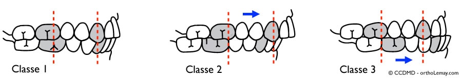 plusieurs types malocclusions dentaires