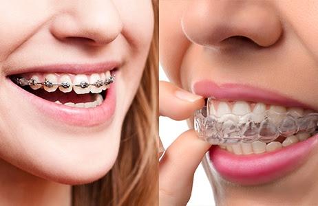 orthodontie invisalign paris prise en charge