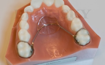 arc de nance orthodontie