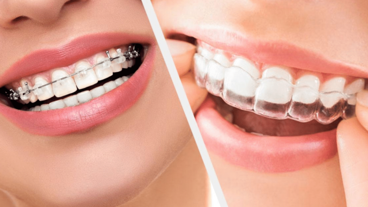 Traitement d'alignement dentaire : Combien de temps ça dure ?