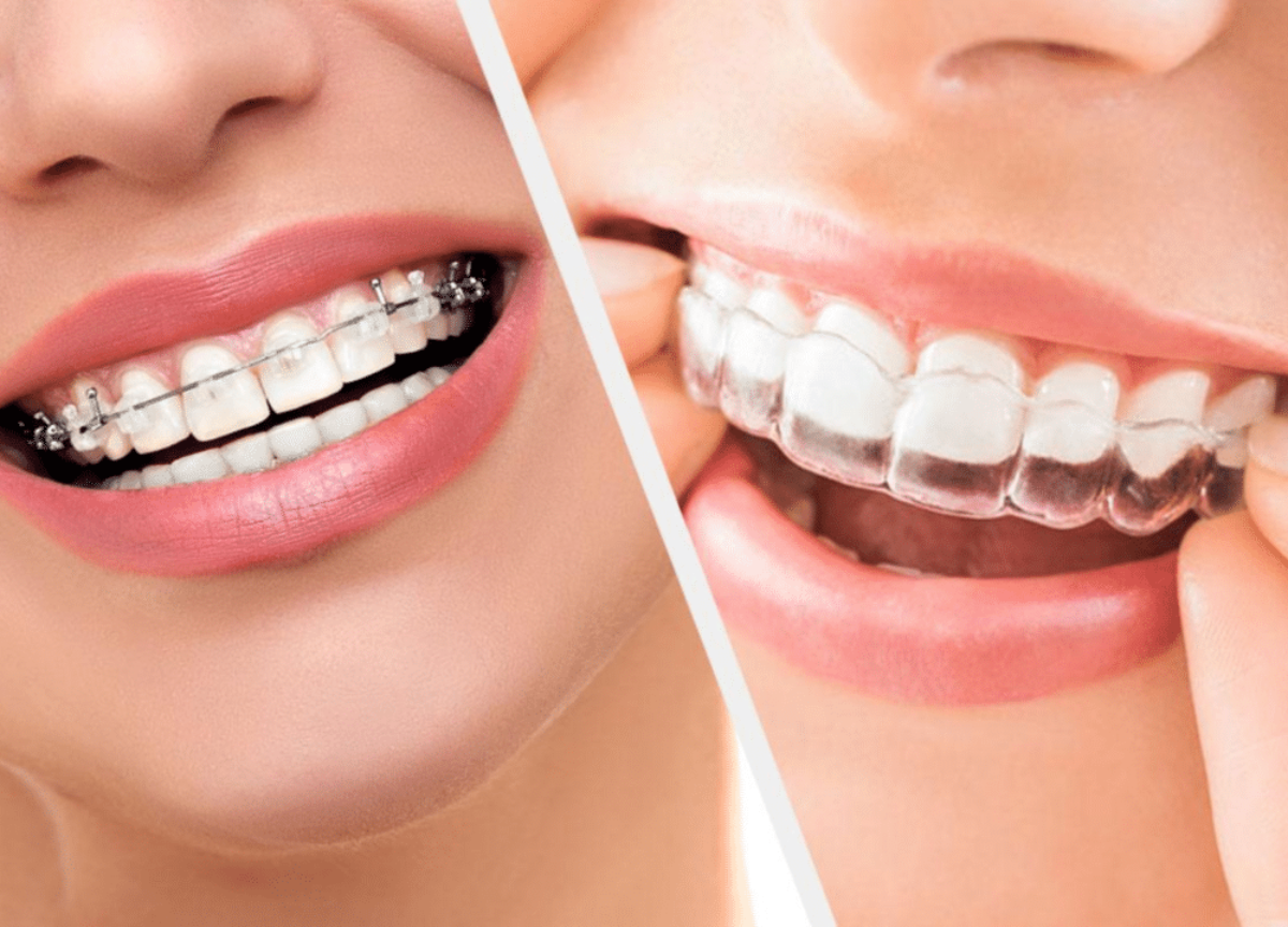 Nouvel appareil orthodontique dentaire Alignement Er pour adulte