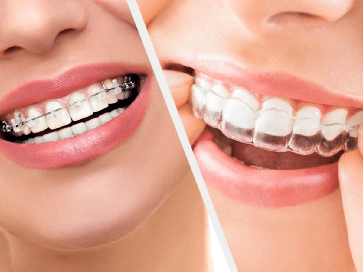 Traitement Orthodontique Adulte Bagues Ceramique Adulte Dentaire