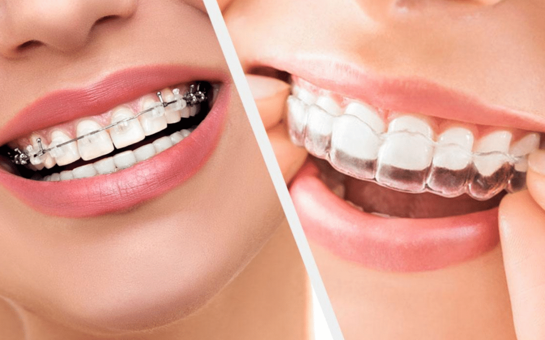 Focus sur les appareils d’orthodontie chez l’adulte !