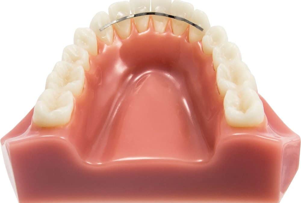 fil de contention en orthodontie