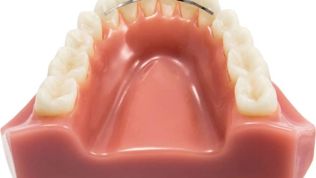La contention. Après le traitement orthodontique actif - SFODF