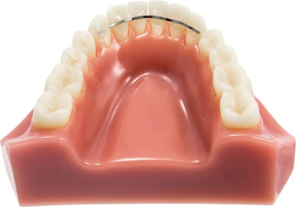 Conseils pour le port des gouttières orthodontiques