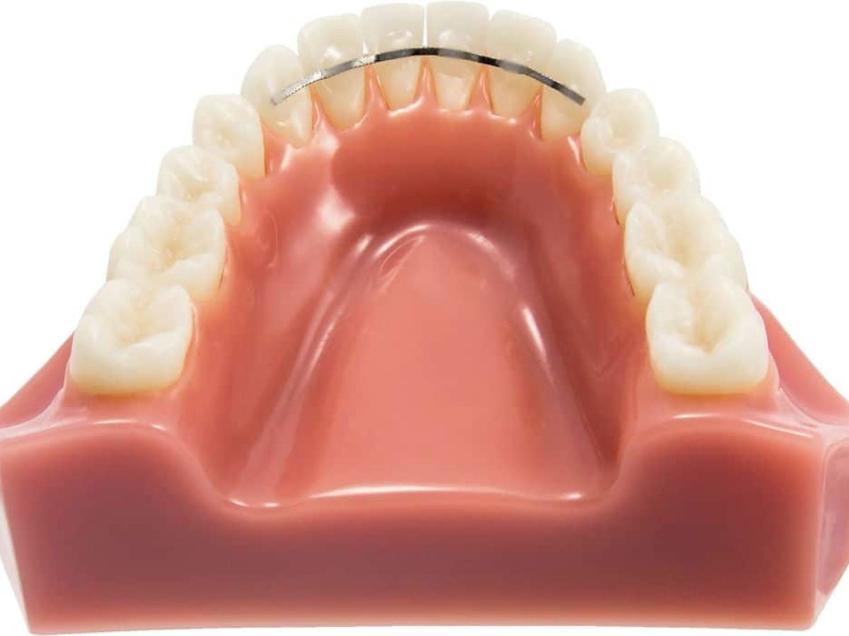 Se faire enlever une dent par votre dentiste : ce qu'il faut savoir