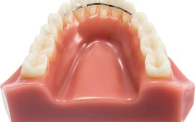 Guide complet sur la contention en orthodontie !