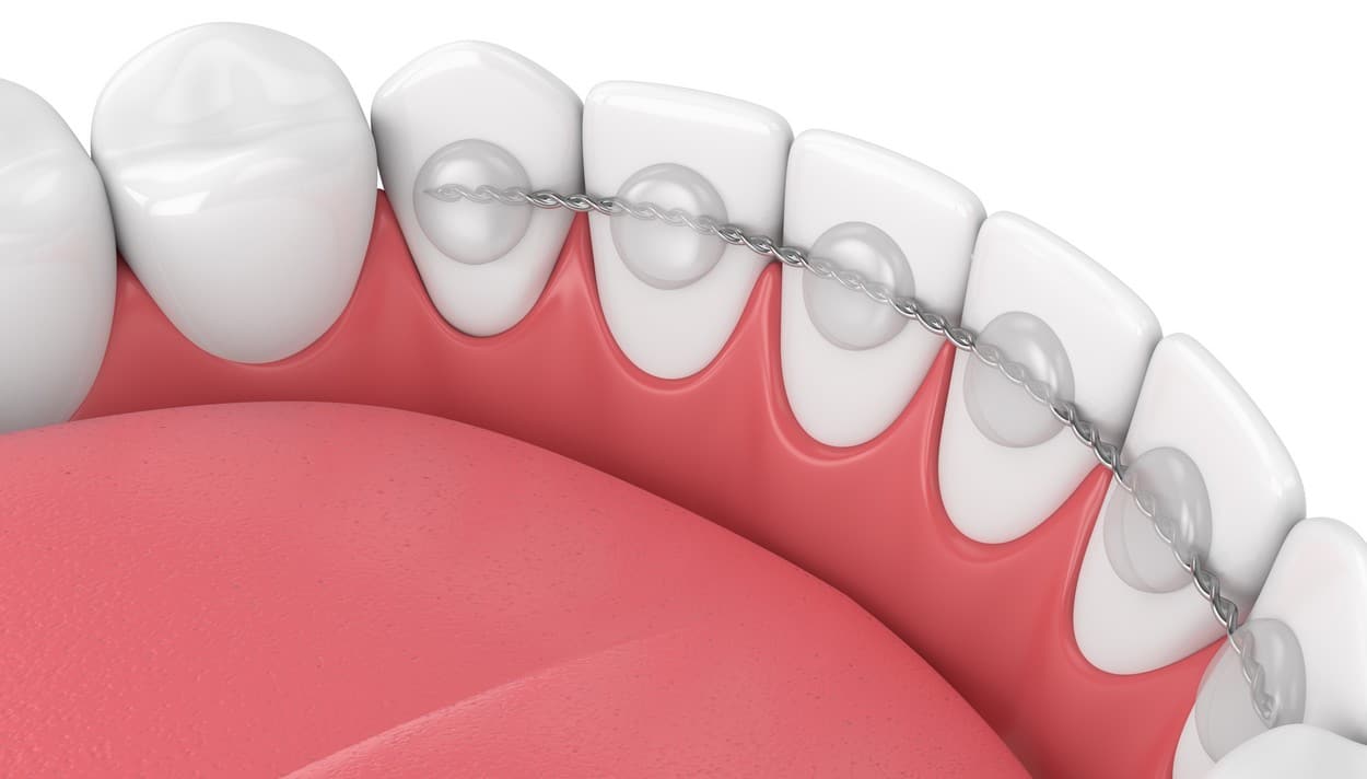 L'importance de la contention en orthodontie