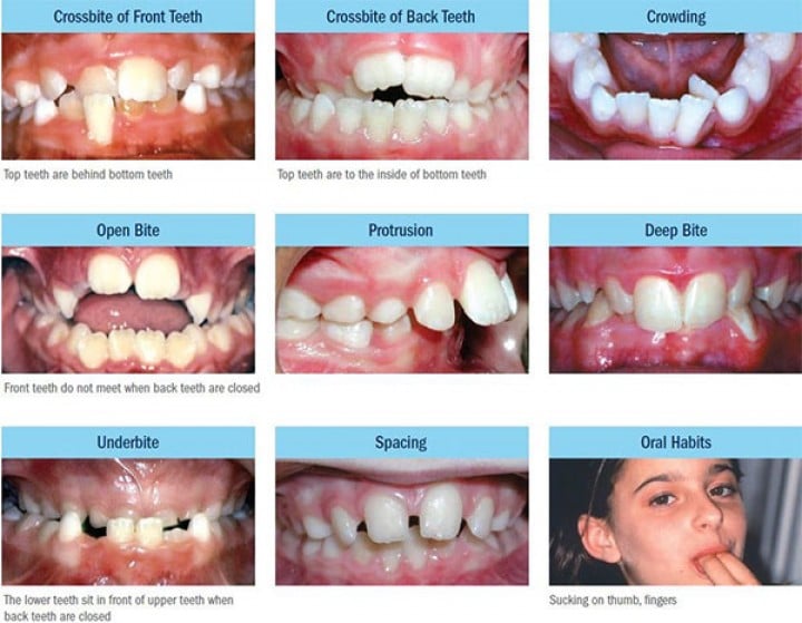 malocclusions chez l'enfant orthodontie interveptive