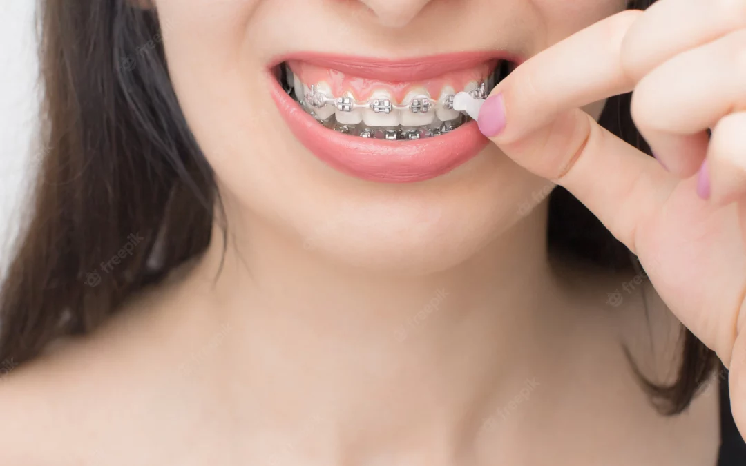 La cire orthodontique : qu’est-ce que c’est et comment l’utiliser ?