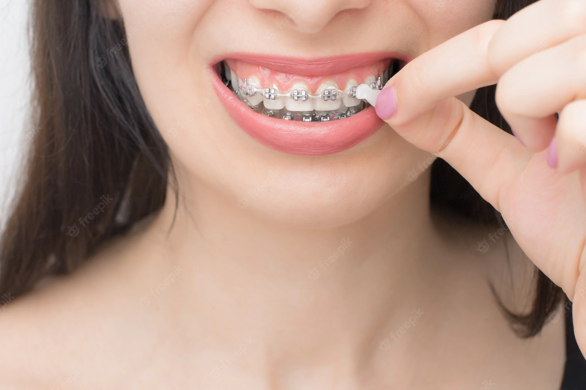 La cire orthodontique : qu'est-ce que c'est et comment l'utiliser ?