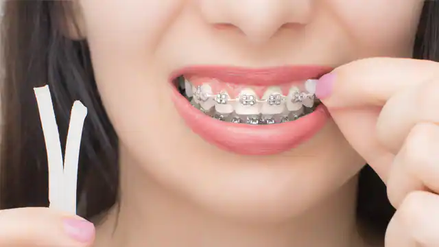 cire orthodontique question reponse orthodontiste paris 8 invisalign