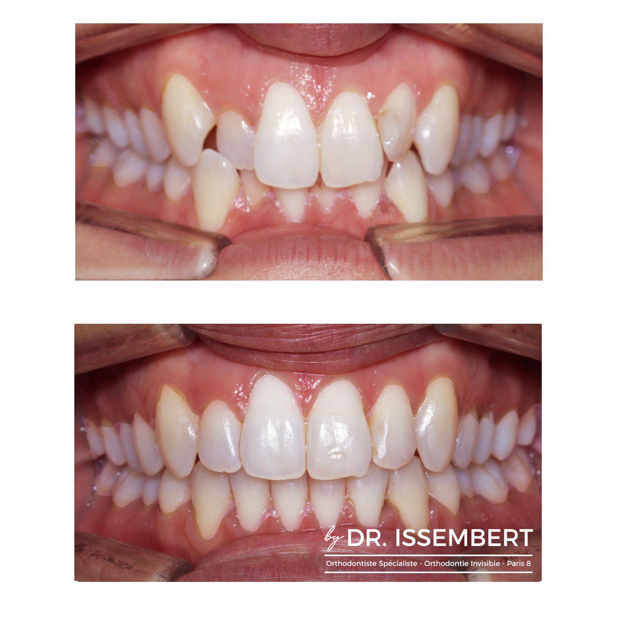 hollywood smile orthodontie dentiste dentaire facettes ou orthodontie avant après bagues gouttières paris