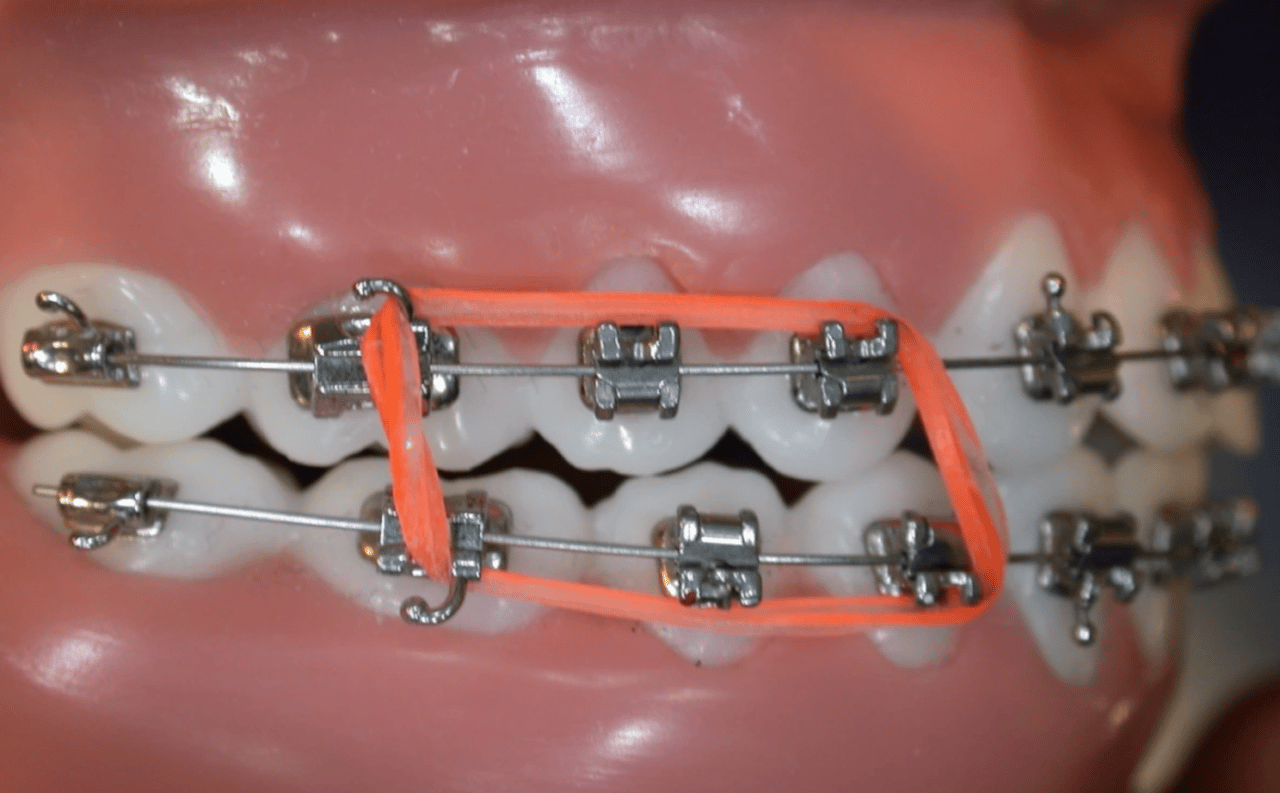 Le guide complet sur les élastiques en orthodontie