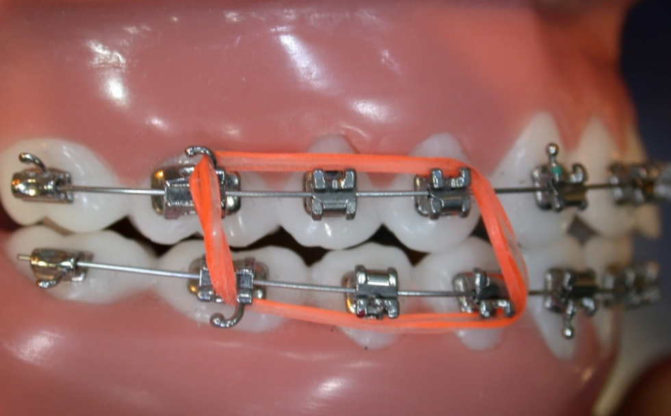 Kit De 100 élastiques Orthodontiques Colorés - Pour Appareils Dentaires, Mixte, Caoutchouc Souple