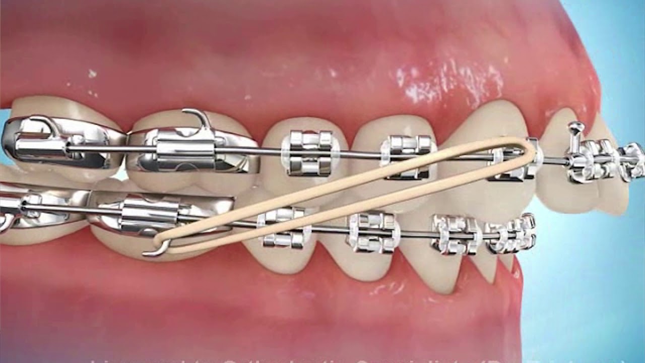 elastique class II 2 orthodontie inter maxillaire