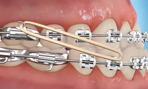 elastique class III 3 orthodontie inter maxillaire