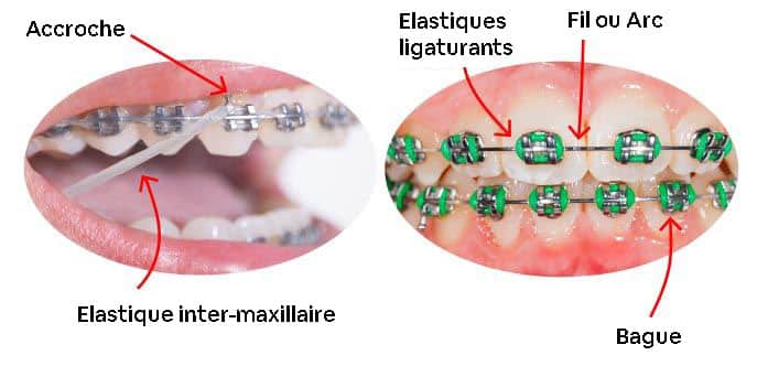 elastiques et bagues ligaturants orthodontiste paris intermaxillaire