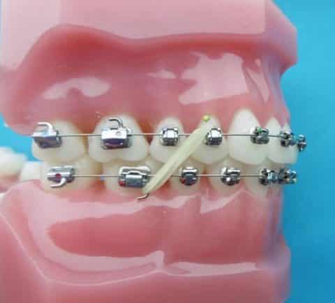 Élastiques Orthodontiques Colorés – Lot D’attaches En Caoutchouc Pour Bagues Et Appareils Dentaires