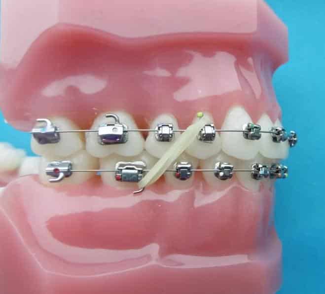 Acheter Élastiques de Correction des dents de qualité médicale, bandes de caoutchouc  dentaires, anneaux en Latex, anneaux orthodontiques