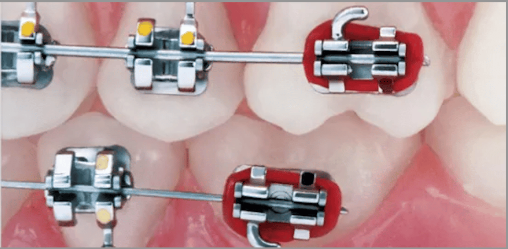 elastiques intermaxillaires orthodontiste paris issembert