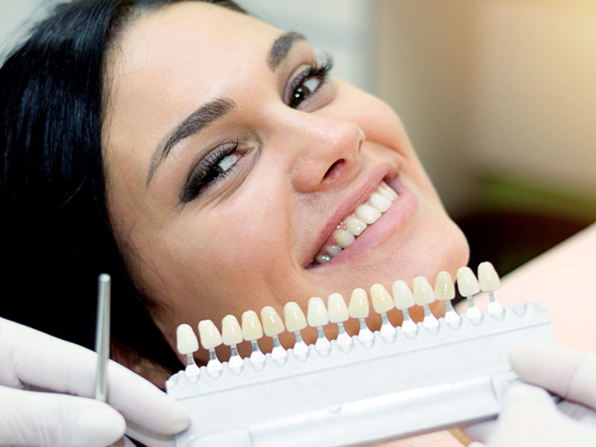 Facette dentaire pour un sourire esthétique blanc et uniforme