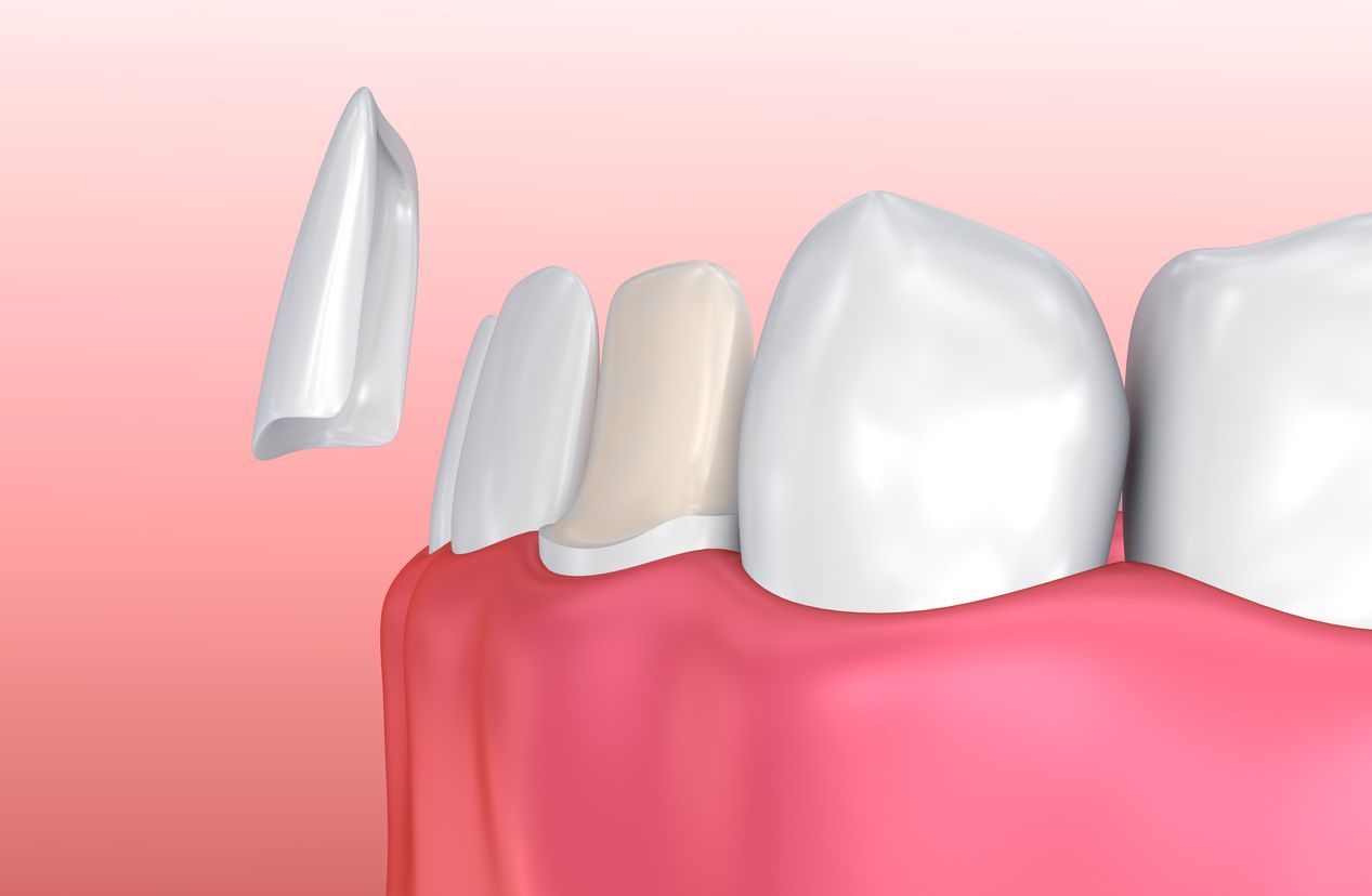 hollywood smile orthodontie dentiste dentaire facettes ou orthodontie bagues gouttières paris 2
