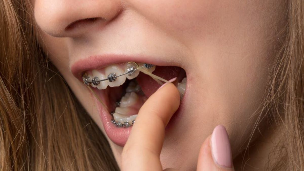 Bandes en caoutchouc orthodontiques moyennes (10 sachets de 100 pièces) -  LEONE