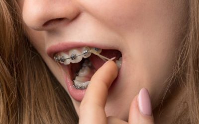Le guide complet sur les élastiques en orthodontie !