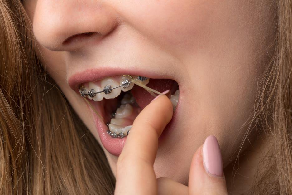 Le guide complet sur les élastiques en orthodontie !