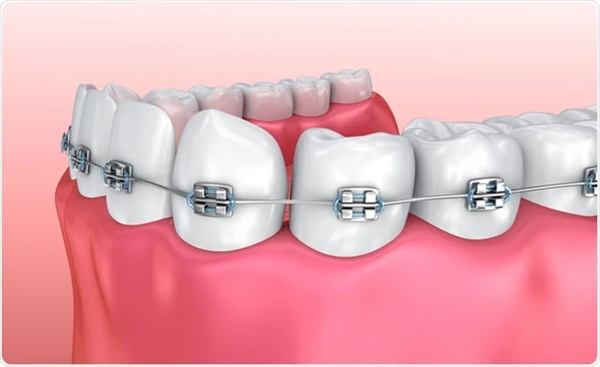 bagues détail orthodontie paris dr issembert meilleur orthodontie