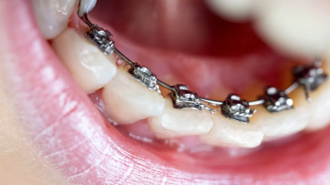 bagues linguales paris orthodontiste dr issembert invisalign