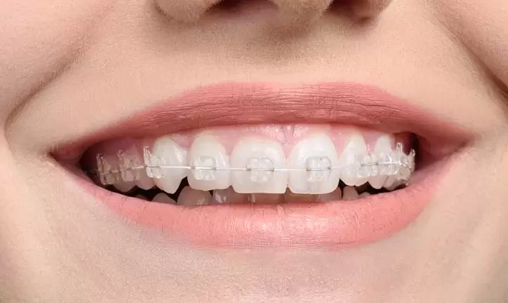 Orthodontiste Bagues Ceramique Dents Dentaire Bague Appareil