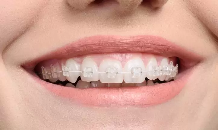 bagues orthodontie paris traitement pas cher invisalign bague céramique dr issembert