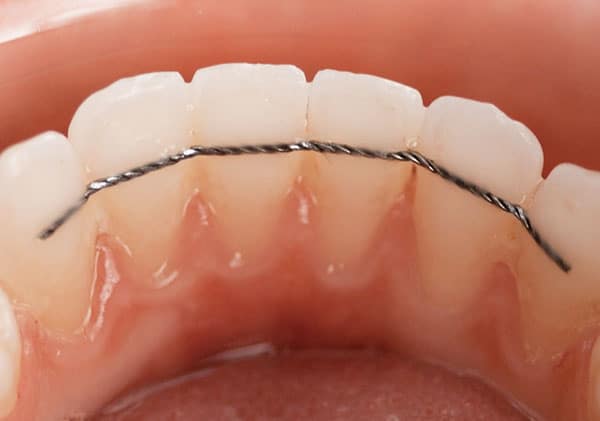 fil de contention orthodontie paris dr issembert